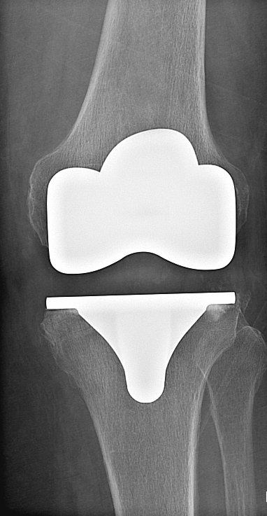 Röntgenbild: Knie-Totalprothese nach der Operation