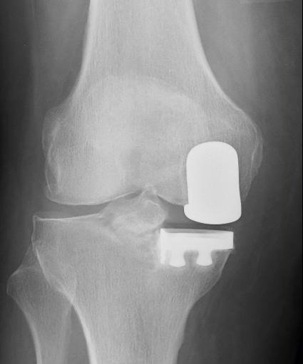 Röntgenbild: Knie-Teilprothese (Schlitten) nach der Operation